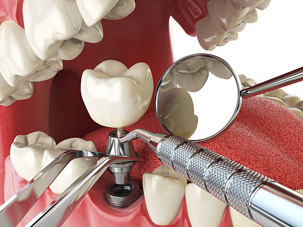 Best Emergency Dentist for Lost Fillings or Crowns in Rathdrum, ID